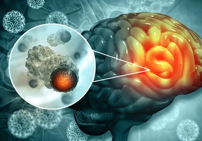 Medical illustration of brain cancer with a microscopic magnification of malignant cells dividing in the tumor microenvironment. Medical illustration of brain cancer with a microscopic magnification of malignant cells dividing in the tumor microenvironment.